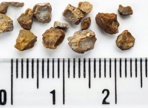 Bệnh sỏi thận có những triệu chứng gì? 8 triệu chứng của sỏi thận bạn không nên bỏ qua